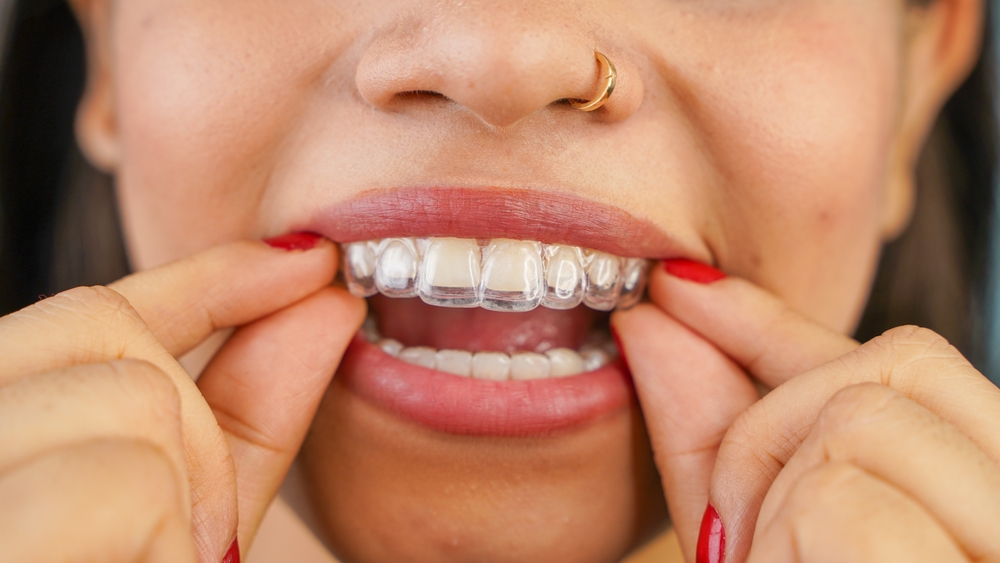 Is Invisalign right for you?