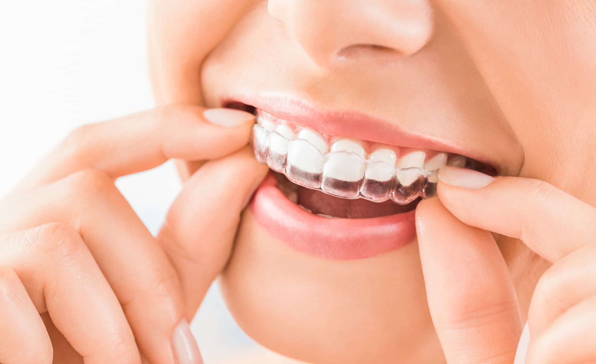 benefits of invisalign