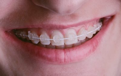 How to Find and Choose the Best Orthodontist