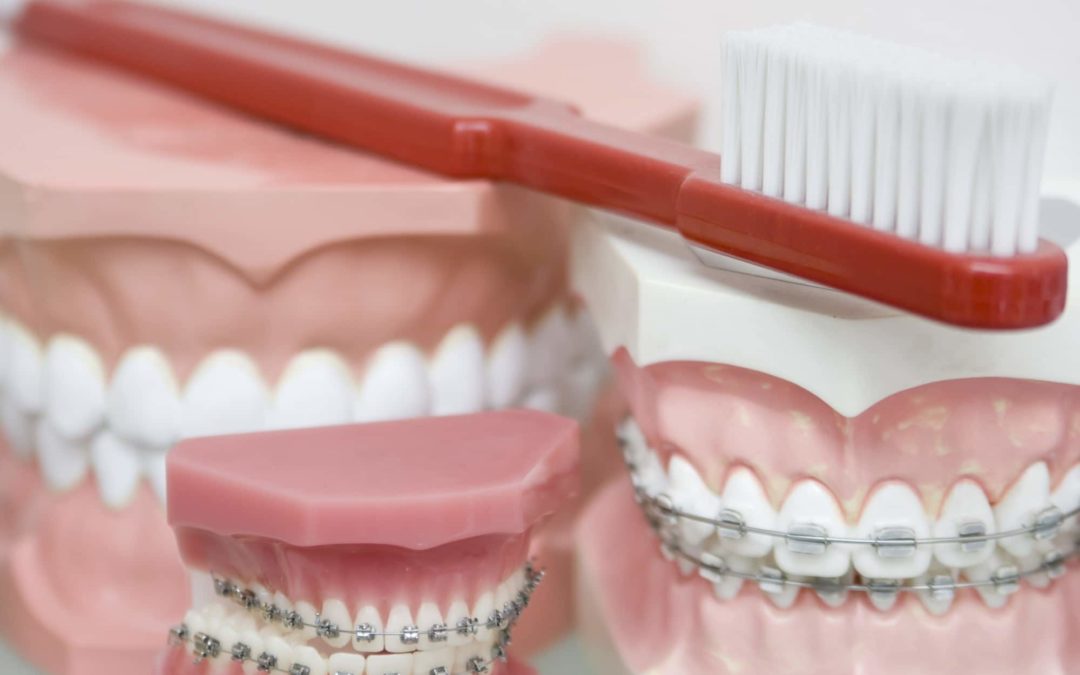 7 Things You Should Know Before Getting Braces as an Adult