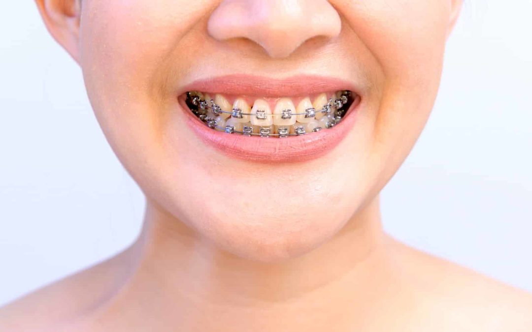 How To Find the Best Orthodontic Treatment in Raleigh, NC