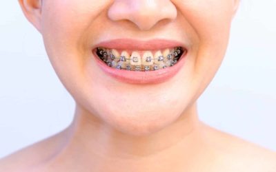 How To Find the Best Orthodontic Treatment in Raleigh, NC