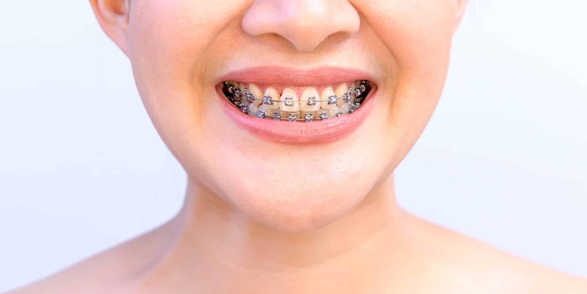 Home | Carolina Braces | Orthodontics | North Raleigh And Brier Creek, NC