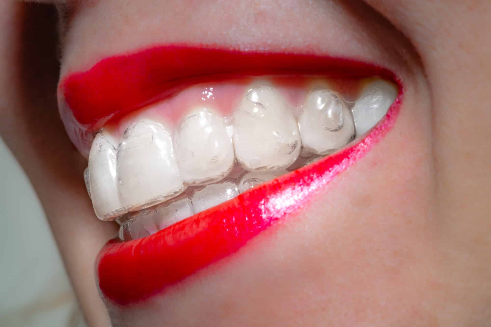 Invisalign